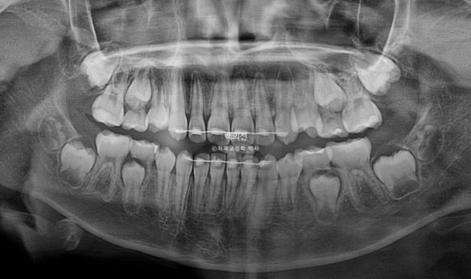 소아 비대칭 교정 인비절라인 퍼스트 재제작 1회 MA 치료 관련 이미지 18