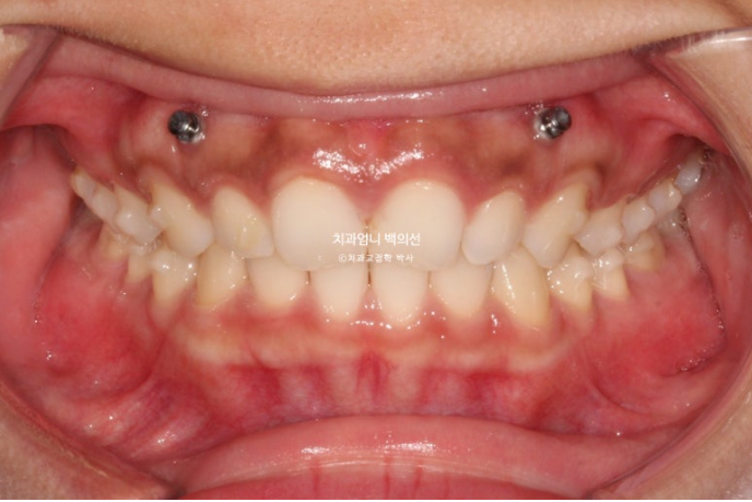 과개교합 옥니 거미스마일 교정 인비절라인 라이트 잇몸성형 후기 관련 이미지 7