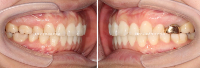 Gummy Smile Correction, Gummy Smile Orthodontics, Rabbit Teeth Correction image 9