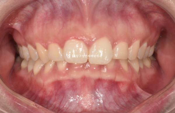 Can't Invisalign Move the Roots? An Actual Case of Extraction Treatment for Protruding Mouth at a Gangnam Orthodontic Clinic image 1