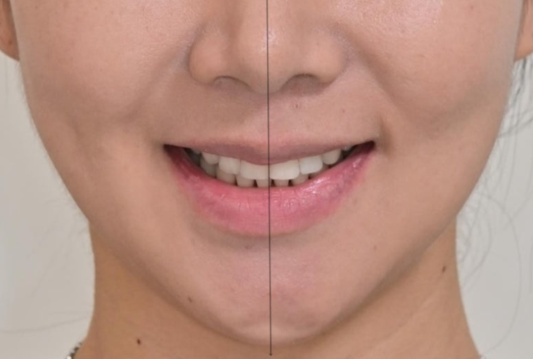 옥니 교정 역교정 재교정 무턱교정 치료기간 1년 10개월 관련 이미지 14