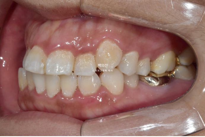 거미스마일 교정 돌출입 발치교정 입술부전 호두턱 치료기간 2년반 관련 이미지 4