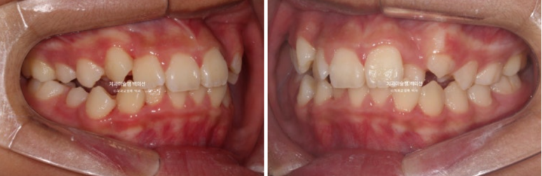 덧니 반대교합 과개교합 인비절라인 퍼스트 악궁확장 어린이 교정 치료 관련 이미지 3