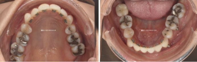How Can Black Triangles Be Removed? Is Re-treatment Orthodontics an Option? image 4