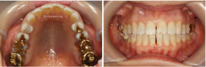 40대 후반 치아교정 해도 될까요? 관련 이미지 3