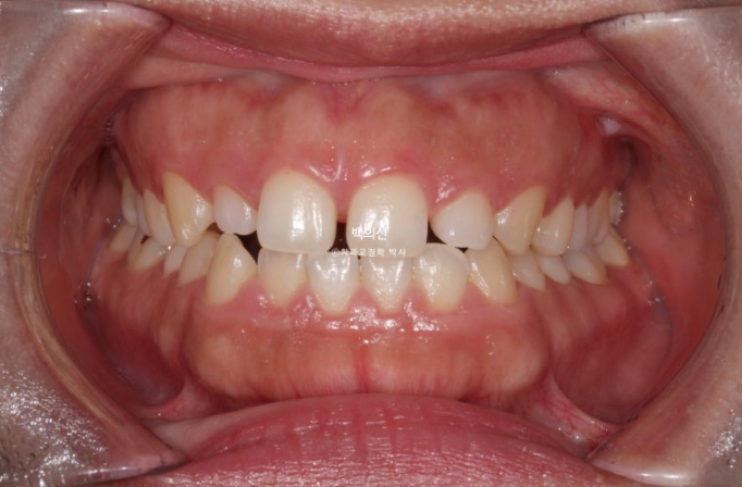 30대 치아교정 돌출입 교정 :: 잇몸미소 거미스마일 교정 입술부전증 결손치 무턱교정 관련 이미지 3