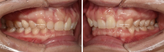 거미스마일 과개교합 교정 잇몸돌출 잇몸 비대칭 관련 이미지 3