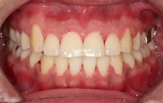 반대교합 비발치 교정 클리피씨 후기 관련 이미지 6