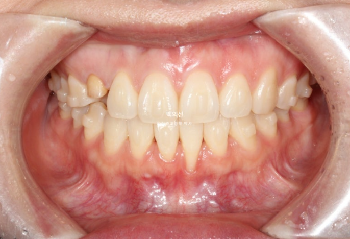 매복 결손 잔존유치 라미네이트 크라운 캔팅 인비절라인 라이트 치료 관련 이미지 13