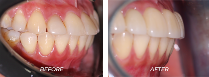 No-Prep Veneers Are Not the Right Treatment for Everyone image 3