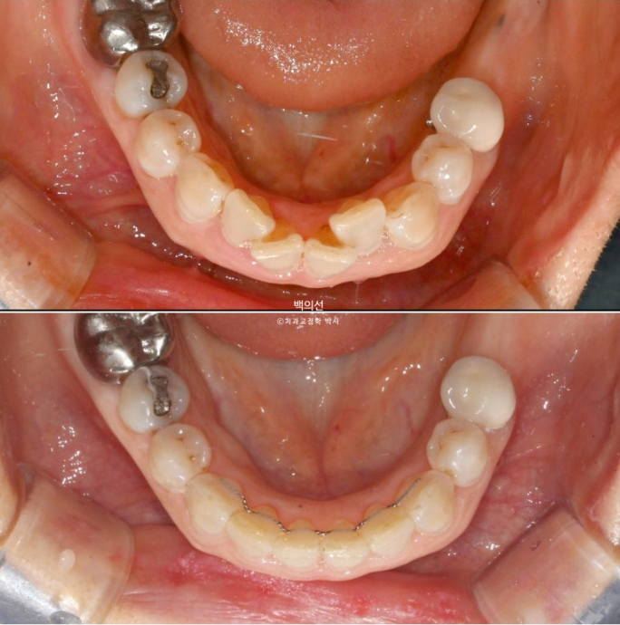 40대 인비절라인 라이트 앞니 돌출 과개교합 덧니 교정 후기 관련 이미지 18