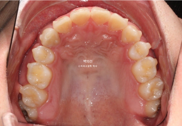 돌출입 수술 ASO + 인비절라인 라이트 후교정 치료기간 10개월 관련 이미지 10