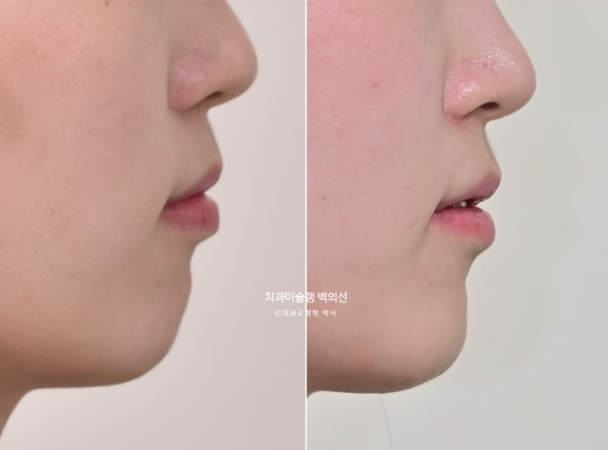 잇몸미소 인비절라인 거미스마일 토끼이빨 교정 무삭제 라미네이트 반대교합 치료 후기 관련 이미지 1