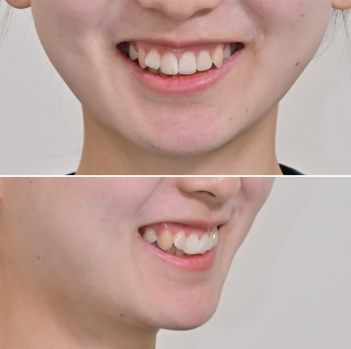 덧니 인비절라인 라이트 잇몸미소 거미스마일 중심선 블랙트라이앵글 관련 이미지 6