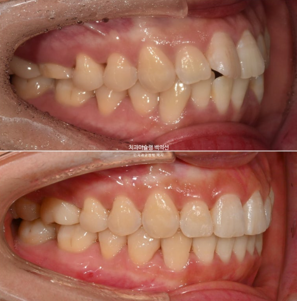 인비절라인 돌출입 발치교정 임플란트 없이 사랑니 대체 관련 이미지 23