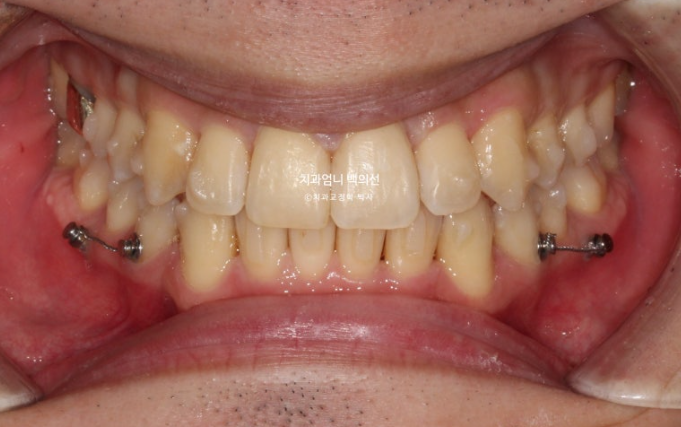 인비절라인 비발치 앞니 돌출 덧니 교정 ? 관련 이미지 7