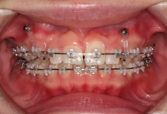 Inward-Tilted Teeth Orthodontic Treatment Review | Actual Case Improved with Non-Extraction Orthodontic Treatment for Gummy Smile, Deep Overbite & Gum Asymmetry — Gangnam Orthodontic Clinic image 5