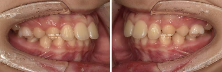 어린이 투명교정 인비절라인 퍼스트 가위교합 돌출교정 덧니교정 관련 이미지 3