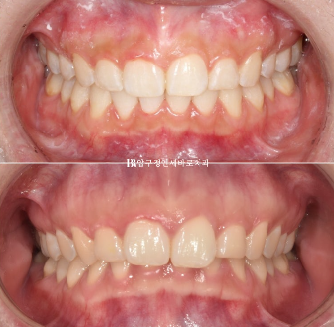 Does Invisalign Prevent Root Movement? Before-and-After Comparison of Extraction Treatment for Protruding Lips image 12