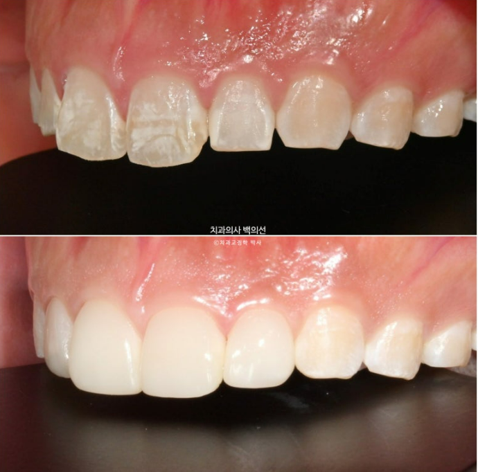 반점치 반상치 치아 하얀 얼룩 치료하기 관련 이미지 7