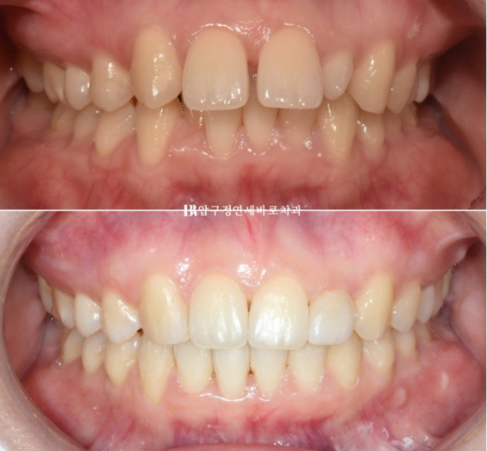 Actual Case of Treating Congenitally Missing and Peg-Shaped Teeth Without Implants image 12