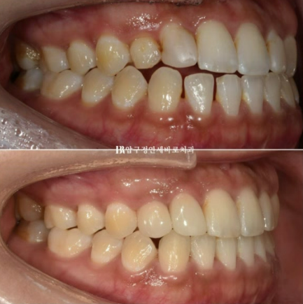 왜소치 치료 잔존유치 무삭제 라미네이트 후기 관련 이미지 13