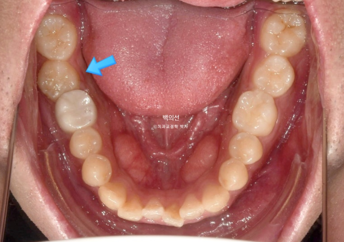 가위교합 나비치아 미니스크류 덧니 교정 인비절라인 라이트 관련 이미지 6