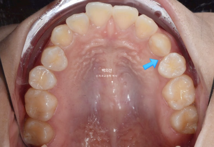 돌출입 교정 인비절라인 발치 교정 개방교합 치료 후기 관련 이미지 4