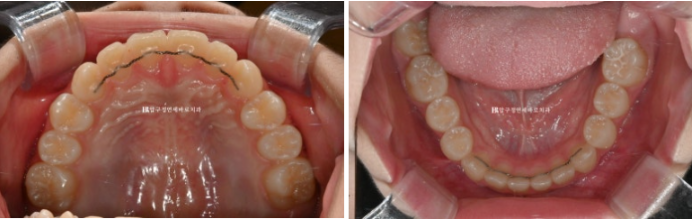 어린이교정 투명교정 인비절라인 퍼스트 후기 관련 이미지 12