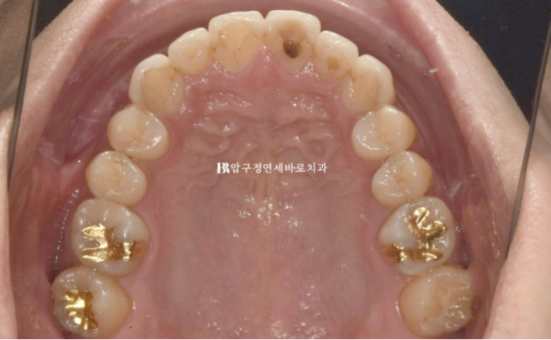 40대 중년 치아교정 인비절라인 라이트 치료기간 8개월 관련 이미지 4