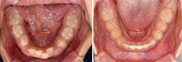 인비절라인퍼스트 어린이 투명교정 과개교합 덧니 악궁확장 돌출 관련 이미지 19