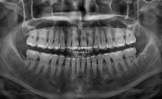 옥니 덧니 과개교합 반대교합 중심선 인비절라인 치료기간 1년 관련 이미지 21