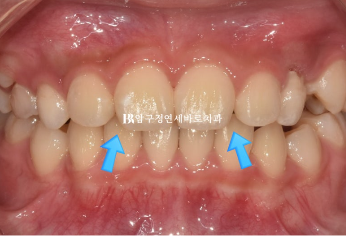 어린이교정 투명교정 인비절라인 퍼스트 후기 관련 이미지 14