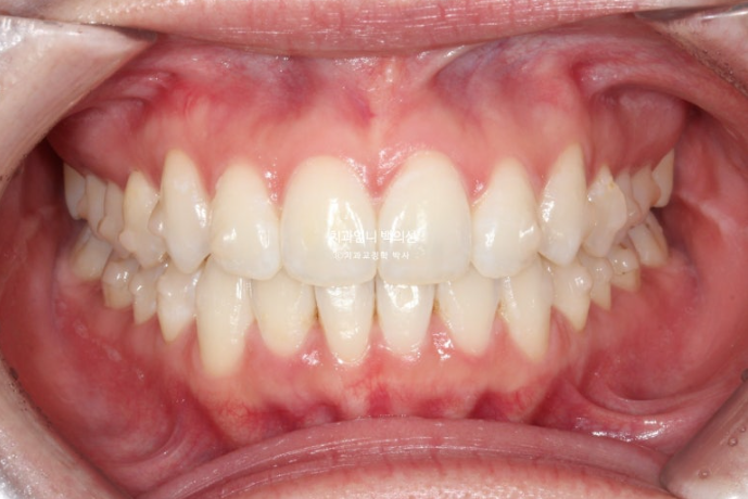 인비절라인 라이트 교정 앞니돌출 과개교합 덧니 교정 관련 이미지 5