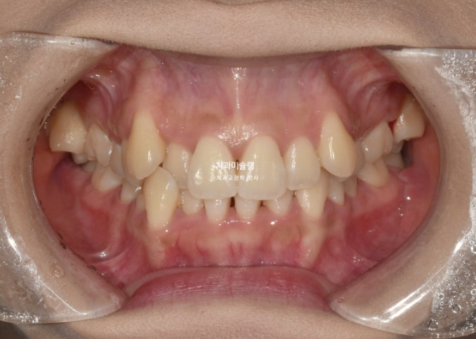 인비절라인 비발치 제2대구치 발치 사랑니 대체 교정 심한 덧니 교정 치료 관련 이미지 2