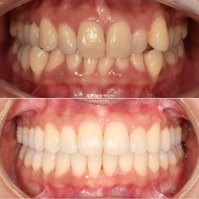 옥니 덧니 과개교합 반대교합 중심선 인비절라인 치료기간 1년 관련 이미지 1