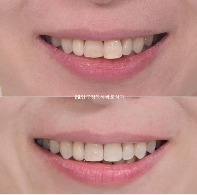 Invisalign Lite for Orthodontic Treatment in Your 40s: Crossbite and Protrusive Mouth Correction image 18