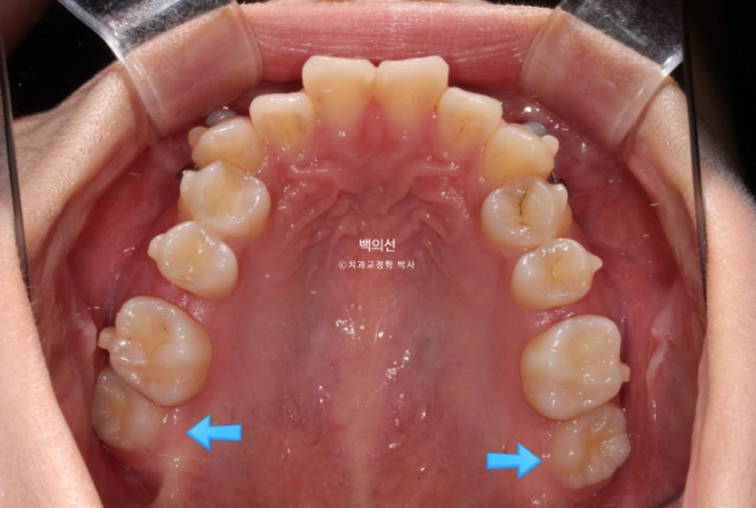 비발치 덧니교정 인비절라인 교정 사랑니 이용 교정 관련 이미지 10