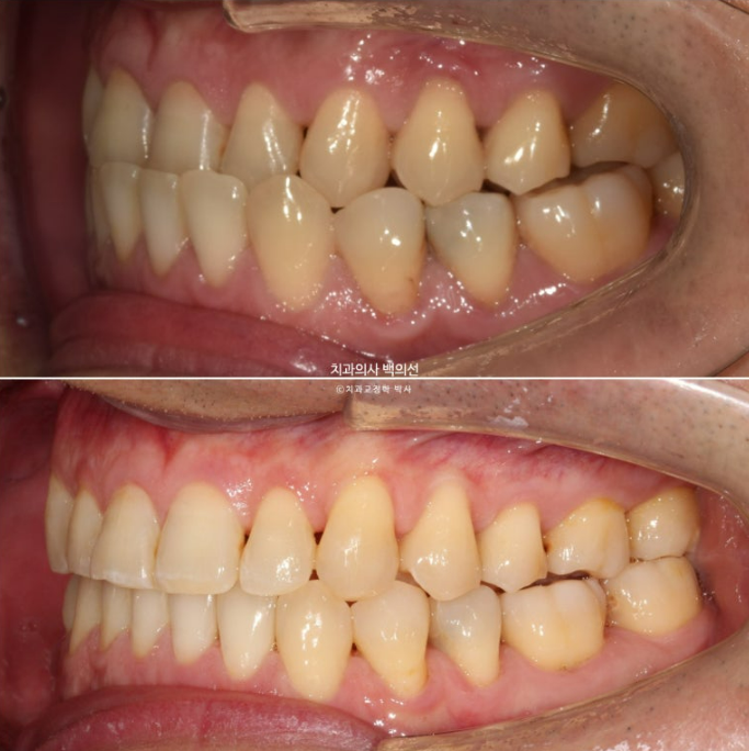 40대 인비절라인 비수술 비발치 주걱턱 비대칭 교정 관련 이미지 13