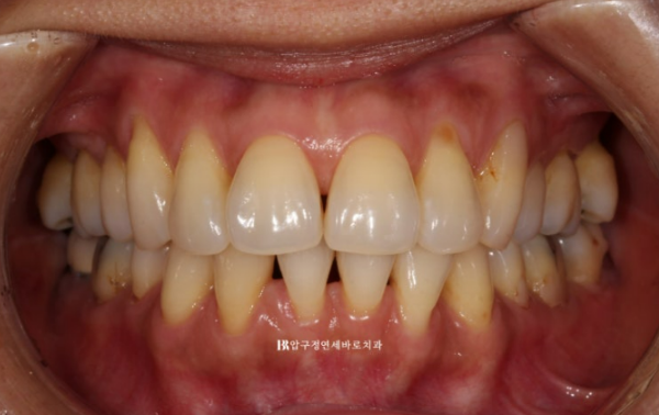 블랙트라이앵글 없애는 교정 가능할까요? 재교정 단기교정 후기 관련 이미지 2