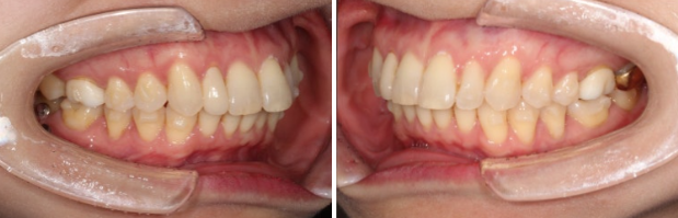 40대 인비절라인 라이트 가위교합? 관련 이미지 11