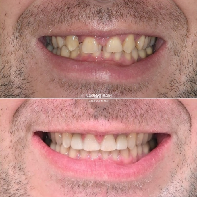 앞니 선천적 결손 인비절라인 임플란트 과개교합 치료 기간 관련 이미지 1