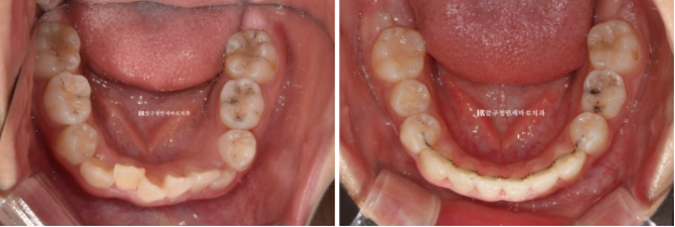 압구정 어린이교정 인비절라인 퍼스트 악궁확장 덧니 교정 관련 이미지 10