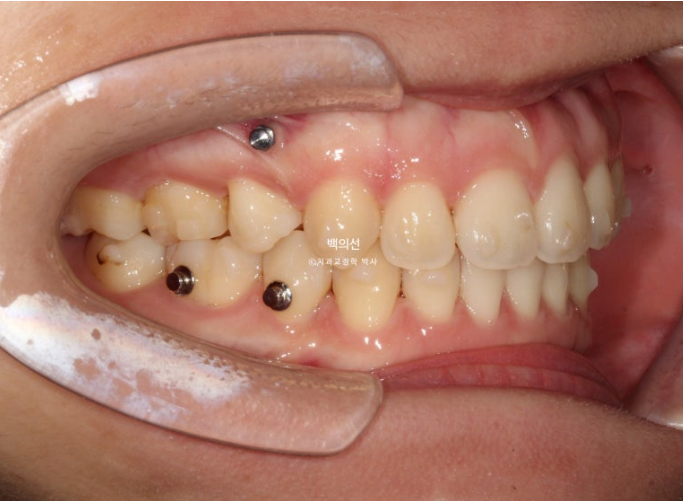 돌출입 교정 인비절라인 발치 교정 개방교합 치료 후기 관련 이미지 14