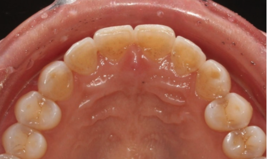 Laminate Veneers in Your 50s: Is It Possible Without Shaving Down the Teeth? | No-Prep Laminate Veneers + Real Case of Front Tooth Partial Orthodontics image 5