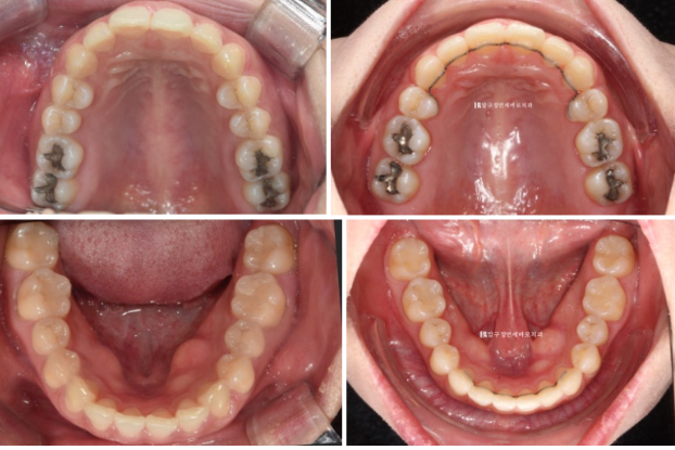 Can't Invisalign Move the Roots? An Actual Case of Extraction Treatment for Protruding Mouth at a Gangnam Orthodontic Clinic image 11