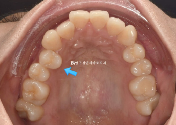 Invisalign Lite Treatment for Crossbite, Rabbit Teeth, and Protruding Front Teeth Correction image 3