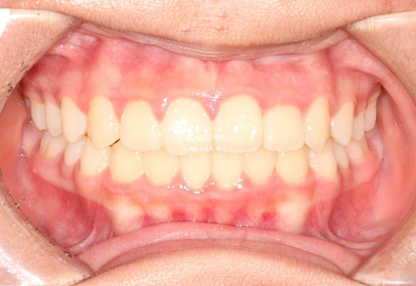 덧니 반대교합 과개교합 인비절라인 퍼스트 악궁확장 어린이 교정 관련 이미지 16