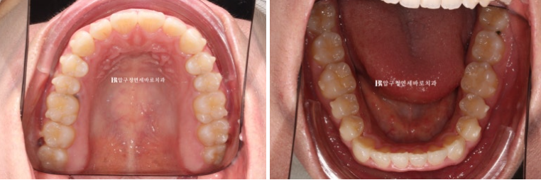 인비절라인 라이트 과개교합 반대교합 돌출입 뻐드렁니 교정 치료 관련 이미지 7