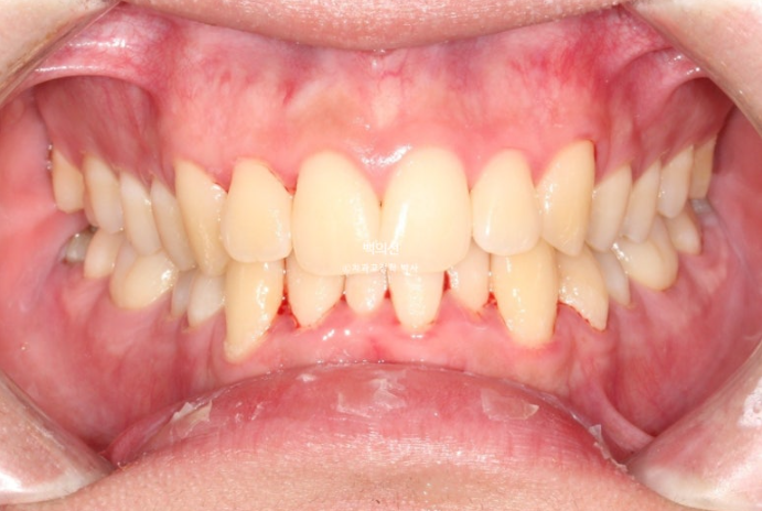 유학생 교정 인비절라인 라이트 치료기간 5개월 관련 이미지 2